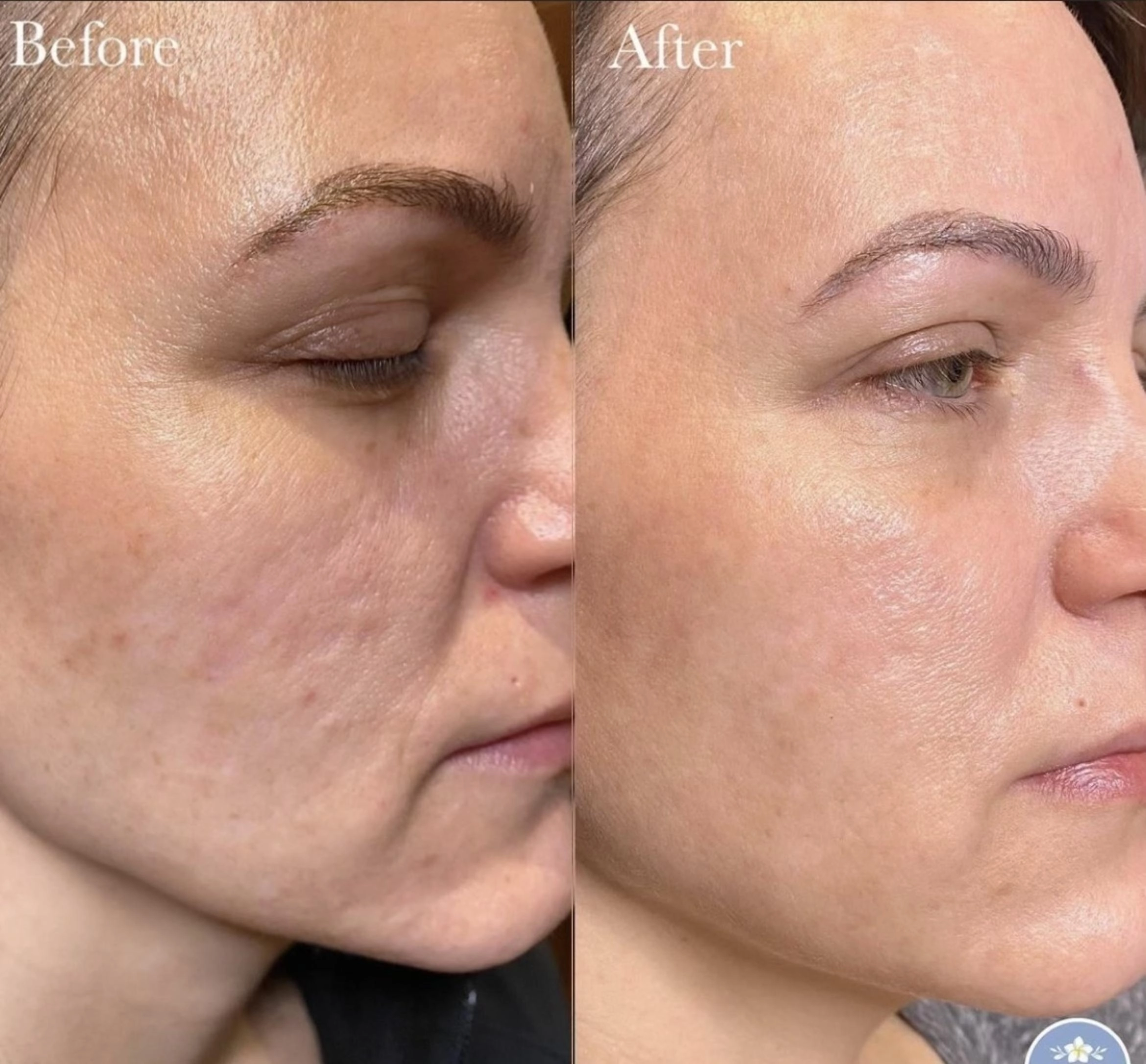 radiofrequency skin tightening 85 right side detail